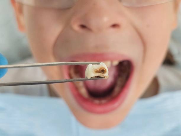 Best Emergency Dental Care for Abscessed Tooth in Slater, MO
